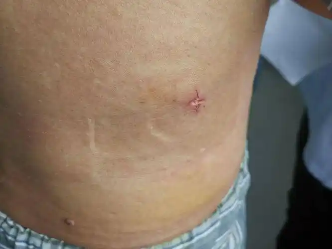 【小南展技术】鸡蛋大小的结石一次取净只留下指甲盖大小伤口?