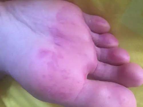 脚底出现红色块快 特别痛