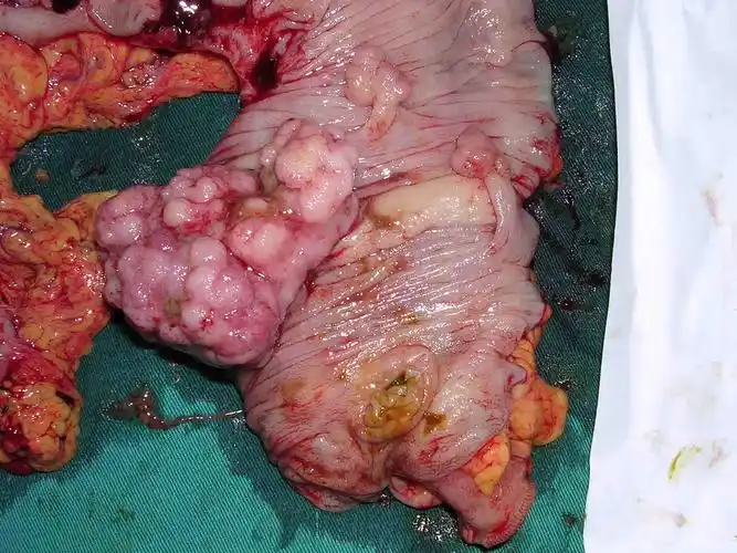 难得的大肠多原发癌照片!