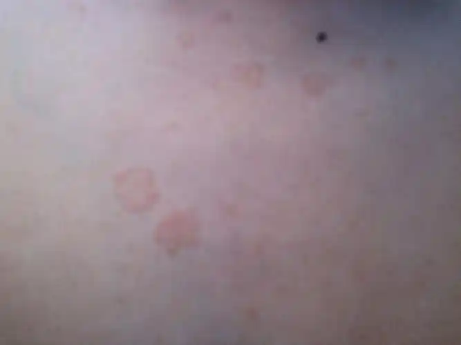 帮忙看看,胸口上的这是什么,去年开始冒出两个没在意.