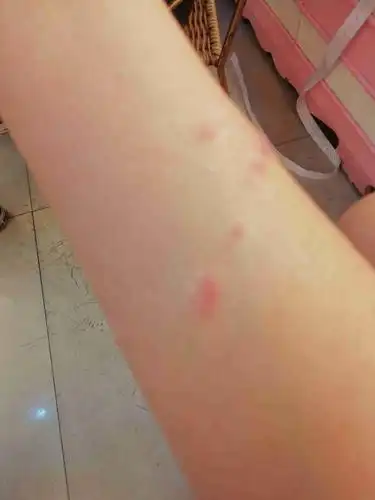 手上不小心被蜘蛛撒尿了,现在红肿有点浓咋办,要消毒吗?三天了