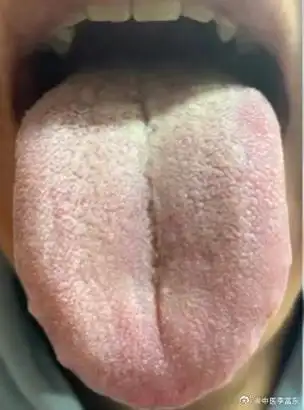 脾虚湿热,心肝火旺,舌苔黄腻?李医生教你一招,祛湿热,泻肝火