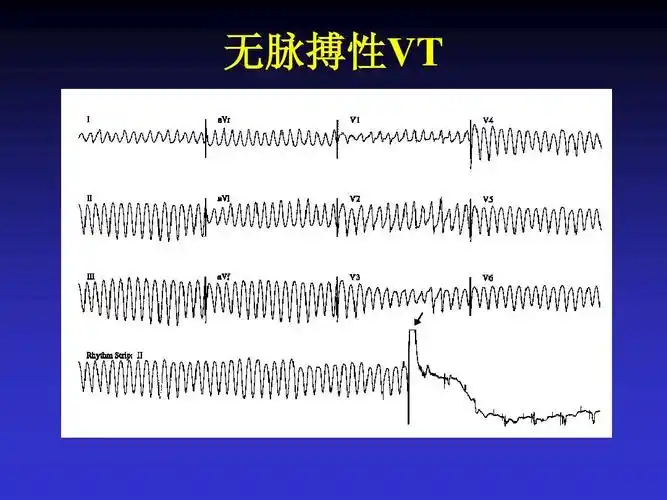 无脉搏性vt