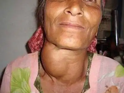 甲状腺结节的饮食护理方法