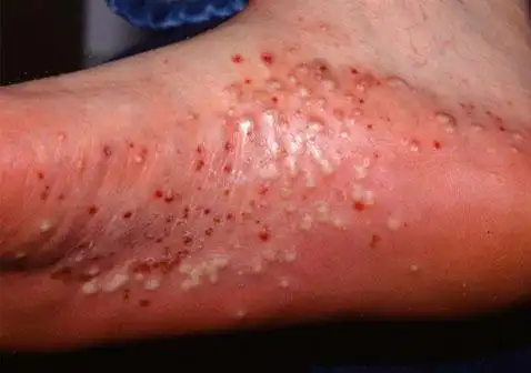 掌跖脓疱病图片