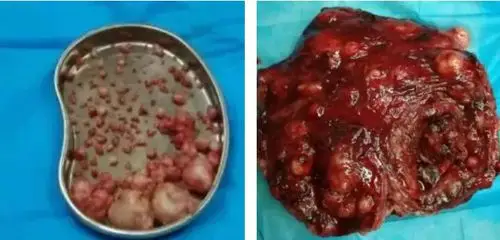 子宫肌瘤子宫腺肌症子宫内膜异位症关系总算理清了