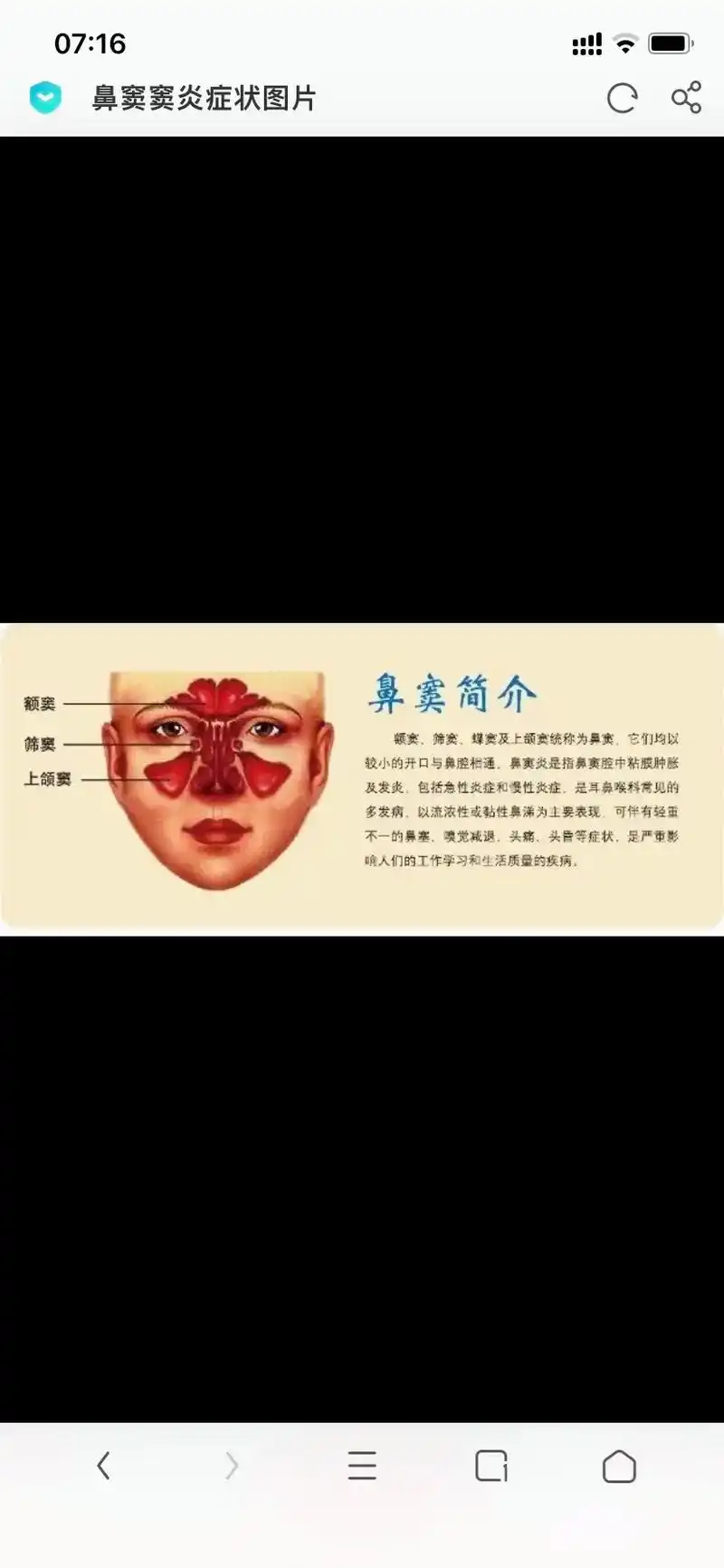 鼻中隔 息肉 致病菌:球菌(主),杆菌 晨起轻,午后重 鼻  - 抖音