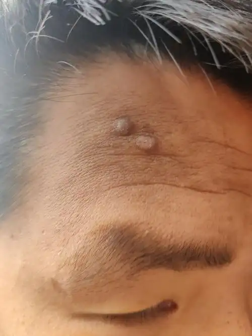 小二不二 的想法: 额头这种结节性痘痘硬块怎么消除? - 知乎