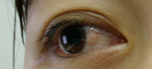 使睑裂斑的变性组织恢复,因为球结膜有自己的修复再生功能,用激光治疗