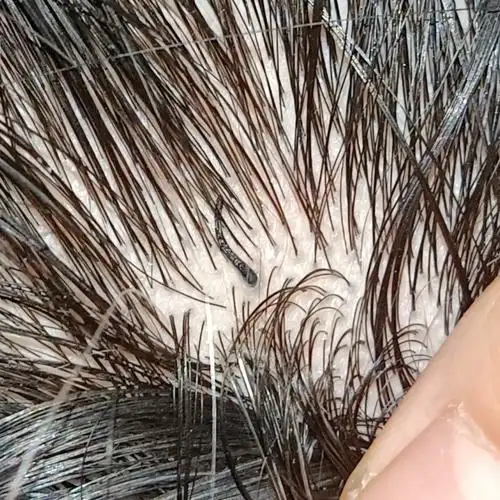 头皮上长了一根粗粗短短硬硬的黑毛(图片有点恶心,介意慎入)