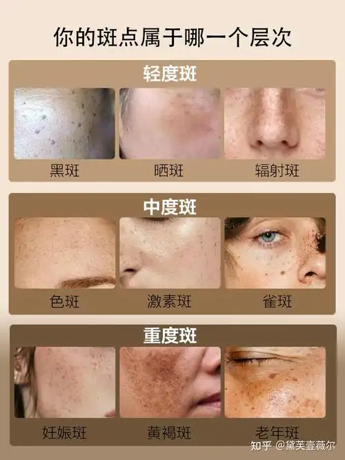 有色斑问题来找小薇哦~没有色斑的脸,穿什么都百搭,十年专注祛斑黛芙