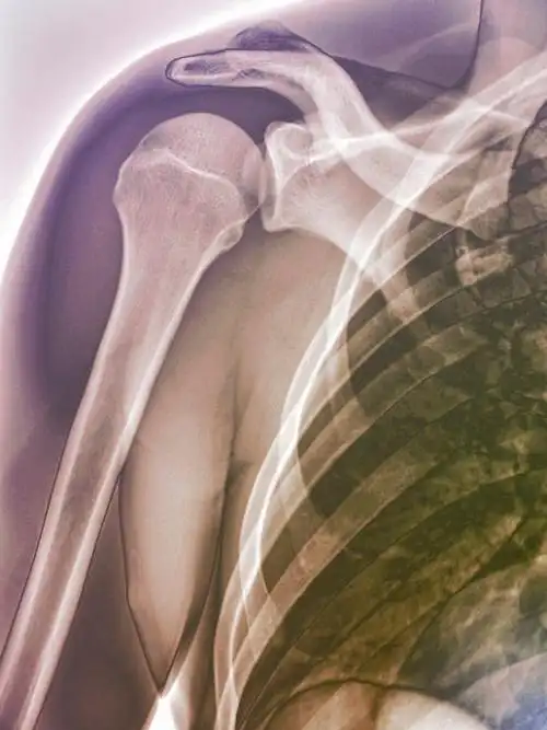 正常肩关节x光片图片下载