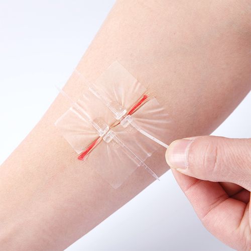 伤口缝合贴拉链式创口贴免缝针拉合皮肤减张器疤痕减张贴 1盒【共2片