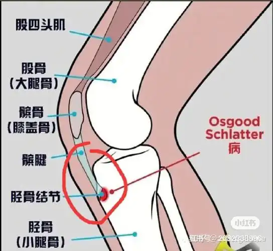 左胫骨结节处的拉伸痛到下楼梯都知道扶着护栏了,现在隆起一个小突起.