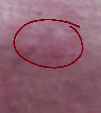 哺乳会不会影响宝宝,疙瘩很少,在乳晕上面,有一点点疼