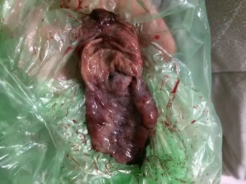 这样需要清宫吗?请大家帮帮忙,谢谢!十分感激!