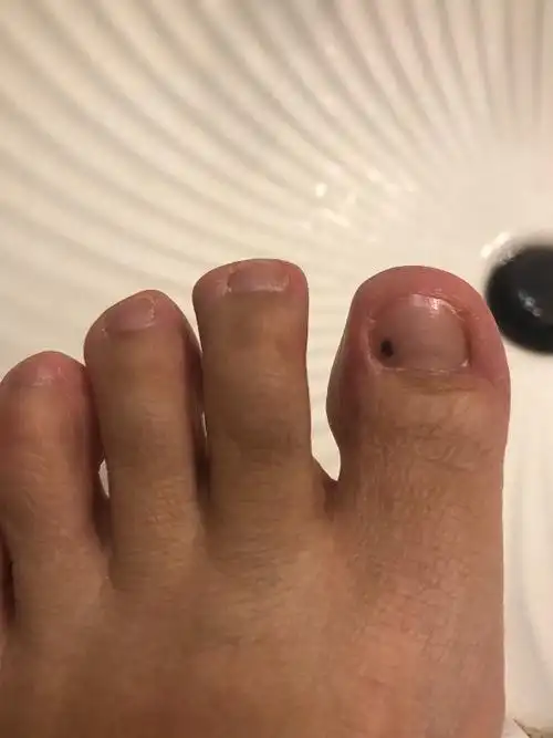 脚趾甲下长了一个黑斑,怎么回事?