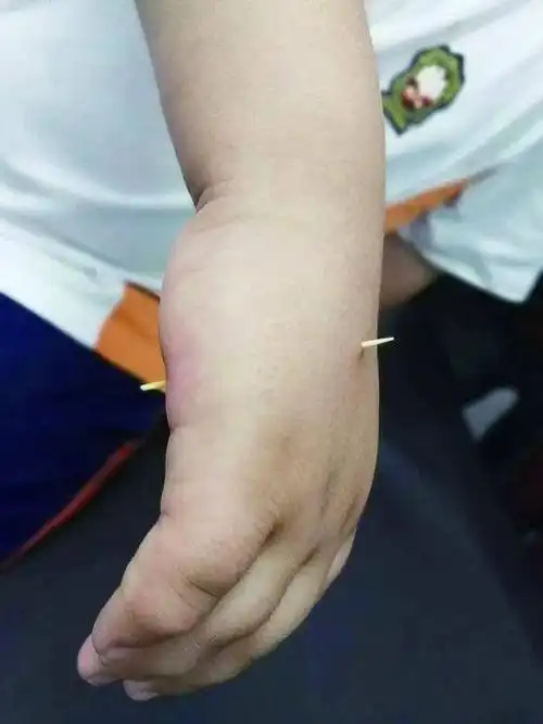 67惊了厦门一女子被牙签轻轻一扎结果竟去医院动了四次手术