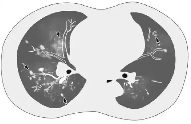 小叶性肺炎是儿童常见的传染性疾病,好发于寒冷季节,注意保暖