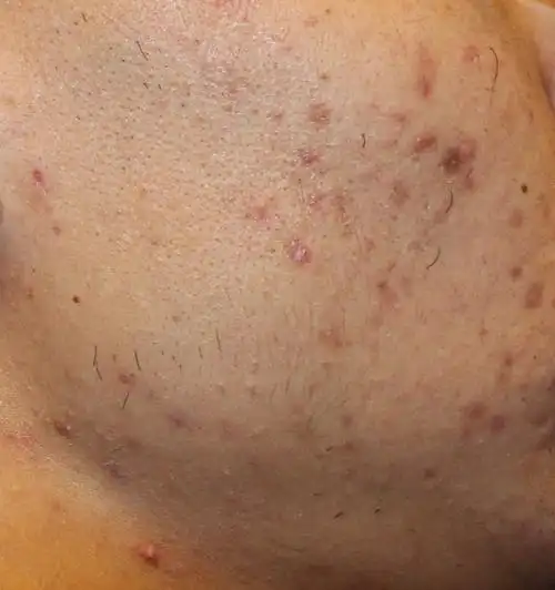 脸上好多小红点,不痛不痒,位于面部两边,持续大半年了; 请问怎么治?