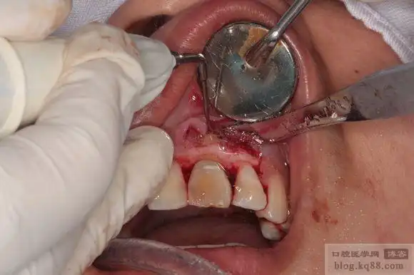 mta修补侧方和根尖倒充填,缝合:术后3个月复查:术前术后对比:术后桩冠