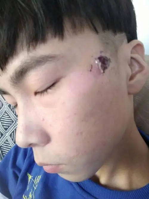 骑车擦伤结痂后掉一部分会留疤吗?