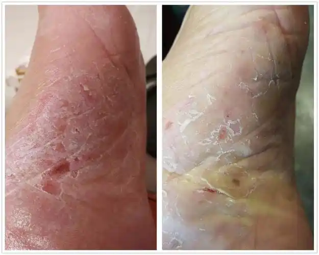 慢性湿疹结节性痒疹特应性皮炎中医中药治疗案例_特应性皮炎_症状