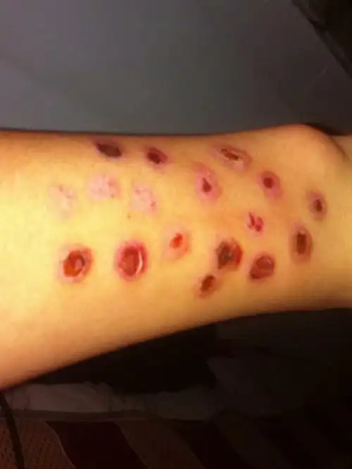 我失恋了,烫的烟疤