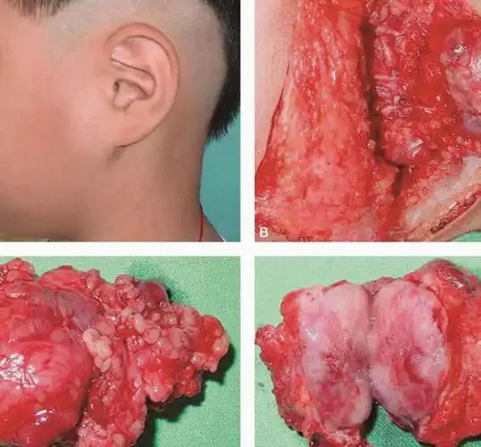 儿童唾液腺上皮性肿瘤的病因,诊断及治疗〔慎入