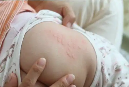 婴儿风疹图片