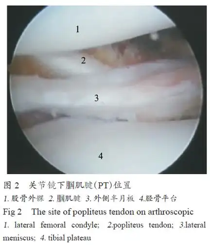肌腱韧带损伤腘肌腱损伤易导致交叉韧带重建疗效不佳