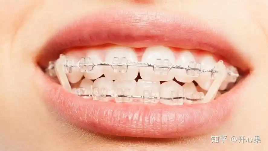 牙齿矫正器的类型