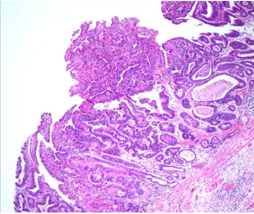 2021版csco胃癌诊疗指南病理详解,重点关注分子分型_医学界-助力医生