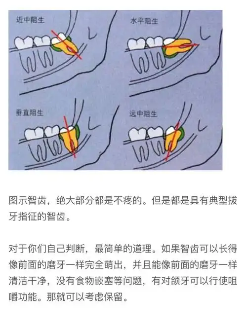来个拔智齿的心得吧97