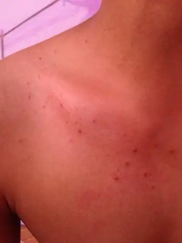 最近几天两侧的脸颊和锁骨那里长了好多红痘痘,看起来像水泡,请问这是