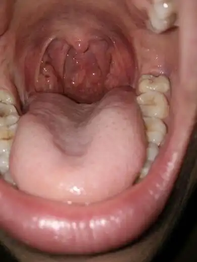 喉咙壁长了好多类似肉陀的黄色颗粒,有时会有点异物