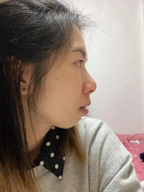 侧脸,还是很凸,不过比之前要自然一点正脸照笑起来自然很多了