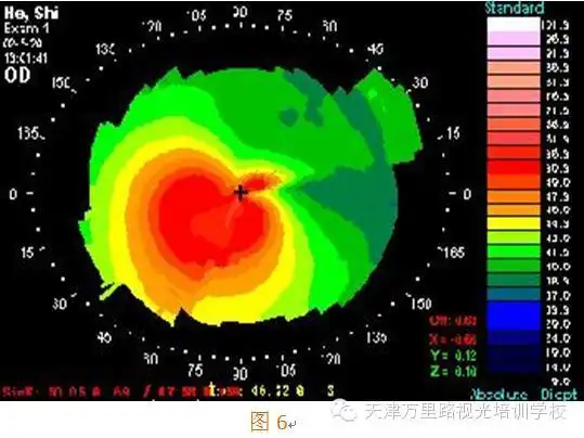圆锥角膜表现为以角膜中央或旁中央区变薄向前突出,呈圆锥形为特征的