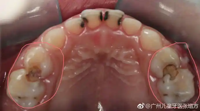 乳磨牙的经典坏法---双邻面龋需要每天使.