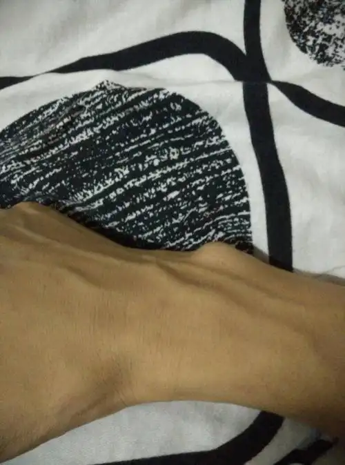 右手手腕处凸起来的比左边大,而且用力按压有痛感,感觉骨头上有层软