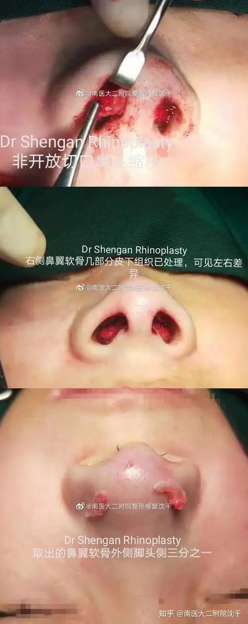 鼻翼缩小# #南京隆鼻#这样鼻小柱不留疤痕,手术后鼻夹板塑形.