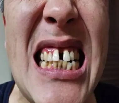 梦见大门牙掉了