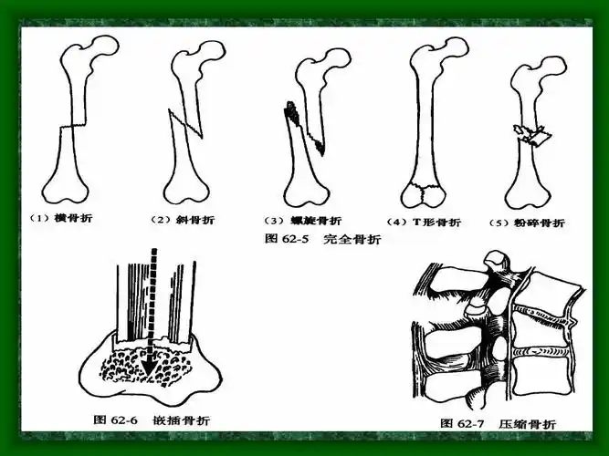 无忧文档 所有分类 医药卫生 1骨折概论ppt