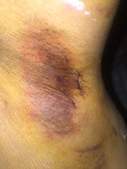 刚做狐臭手术五天了,当时因为做完手术医生让我照什么东西说愈合伤口