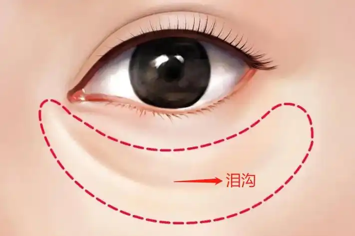 泪沟图片