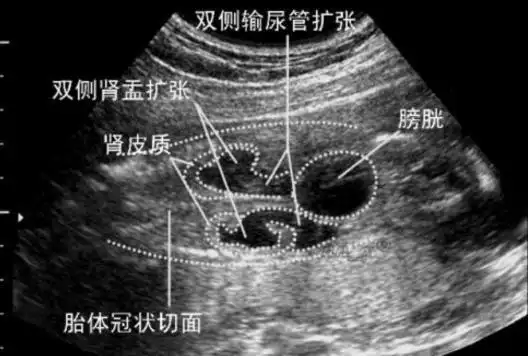 如果做的四维彩超上有"双侧肾盂分离",那90%是男孩,如果是"双侧肾盂