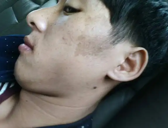 脸上肝斑图片54