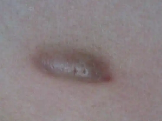 我胸口有个小疙瘩