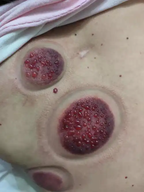 治疗疾病医患信任是治病的基础|水泡|拔火罐|医患_新浪网