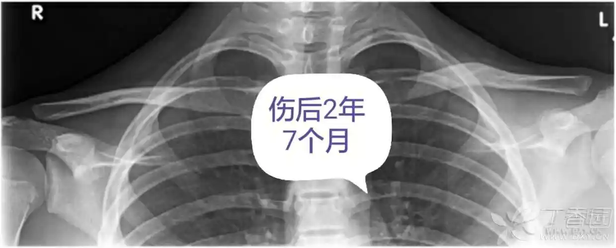 锁骨骨折4个月,畸形愈合---发展趋势如何? [病例帖]